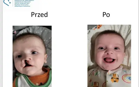 Uśmiechnięte dziecko po korekcie rozszczepu wargi. Wcześniej widoczna była zajęcza warga.
