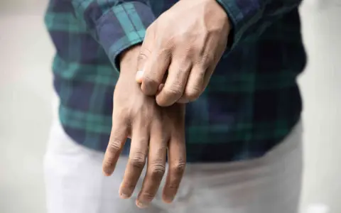 Uomo con camicia a quadri che si gratta il polso, soffrendo di prurito in tutto il corpo.