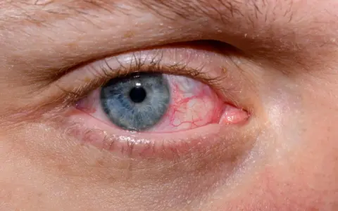 Occhio azzurro con congiuntiva arrossata e vasi sanguigni evidenti. Esistono gli occhi rossi, un segno di irritazione o infezione.