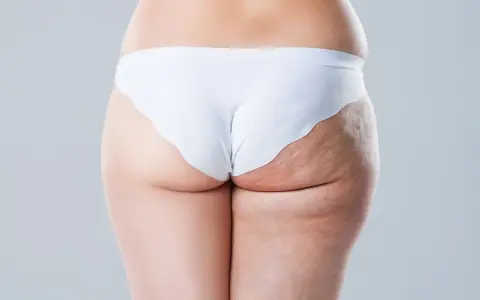 Vue arrière d'une femme en culotte blanche, montrant la cellulite sur sa cuisse.