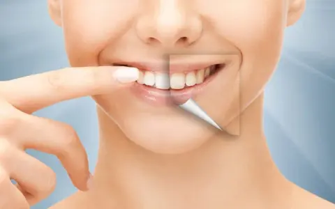 Ile kosztuje Hollywood Smile: kompletny cennik zabiegów w 2025 roku