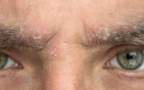Gros plan sur un sourcil qui gratte et pèle, avec des squames blanches visibles sur la peau et entre les poils.