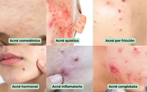 Seis tipos de acné: comedónico, quístico, por fricción, hormonal, inflamatorio y   conglobata.