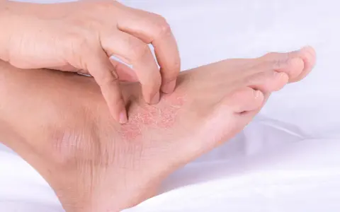 Una mano se rasca la piel escamosa y enrojecida de un pie, mostrando los efectos de la psoriasis en los pies.