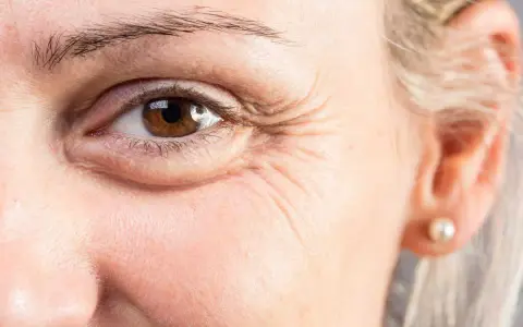 Gros plan sur un œil marron, avec des rides marquées. Une cuillère froide sur les yeux pour soulager les cernes.