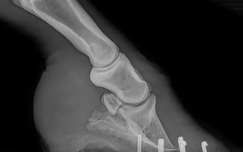 Radiographie d'un pied de cheval montrant une fourbure avec une perforation de la sole.