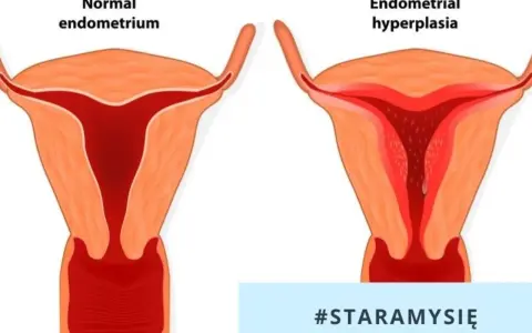 Porównanie prawidłowego endometrium z przerostem. W przypadku przerostu endometrium, zabieg jest kluczowy dla zdrowia.