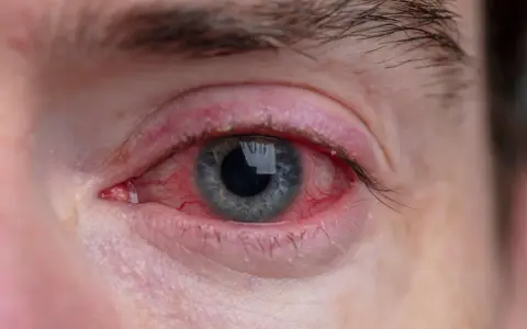 Silnie zaczerwienione oko z widocznymi naczynkami, objaw chlamydiowego zapalenia spojówek.