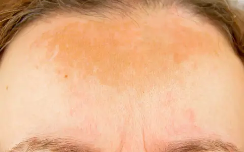 Nierównomierne plamy po solarium na czole, z zaczerwienieniami i przebarwieniami.