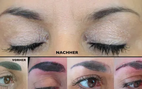 PMU entfernen: Was Sie über Laser, Remover & Kosten wissen müssen