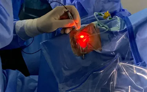 Un chirurgo esegue una vitrectomia, un intervento per rimuovere il corpo vitreo dall'occhio.