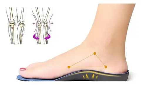 Un pied avec une semelle orthopédique, montrant le soutien. Le podologue utilise ces semelles pour corriger la posture.