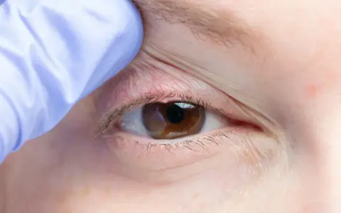 Occhio con palpebra sollevata da guanto blu, evidenziando arrossamento e possibili ghiandole di meibomio ostruite, cause di disagio.