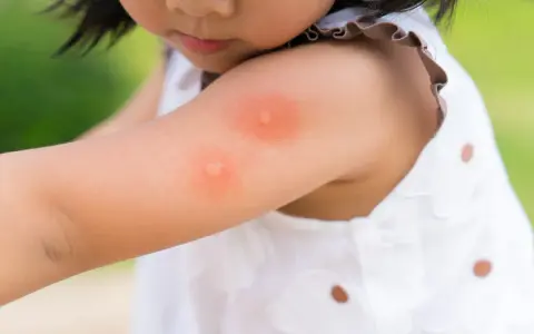 Enfant avec une piqûre d'insecte sur le bras. Une huile essentielle pourrait soulager la démangeaison.
