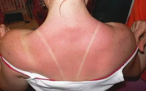 Dos lignes claires sur un dos rouge vif, témoignage d'un coup de soleil. Pour savoir comment faire dérougir un coup de soleil, il faut hydrater et apaiser la peau.