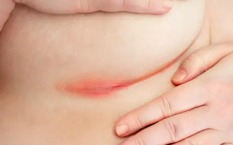 Irritazione cutanea sotto il seno, con rossore e possibile puzza dovuta all'umidità e al calore.