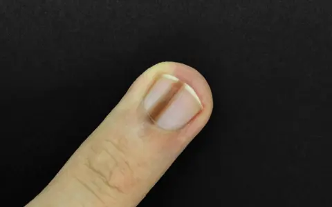 Un ongle de doigt présente une ligne verticale brune, un signe possible de carence en fer.
