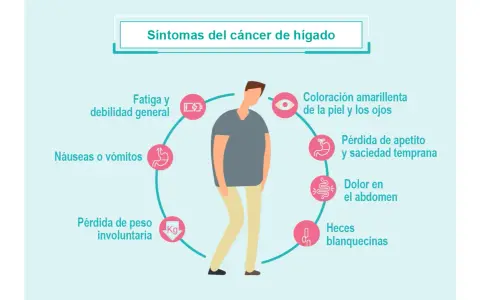 ¿Cáncer de hígado? Conoce sus síntomas y actúa a tiempo