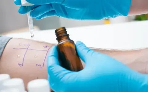 Na ile przed testami alergicznymi odstawić leki, aby uzyskać dokładne wyniki?