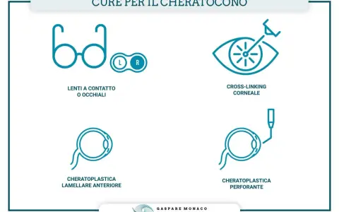 Illustrazione delle cure per il cheratocono: lenti, cross-linking, cheratoplastica lamellare e perforante. Queste opzioni aiutano a gestire le conseguenze del cheratocono.