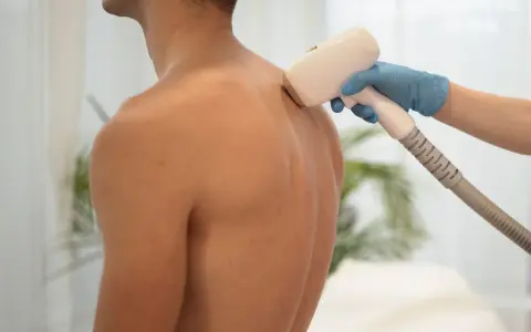 Zabieg depilacji laserowej pleców u mężczyzny. Włosy na plecach u mężczyzn przyczyny mogą być różne, ale nowoczesne metody pozwalają na trwałe ich usunięcie.