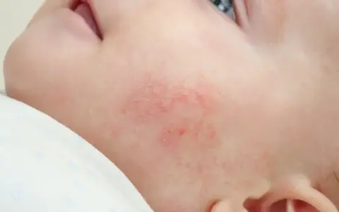 Un petit bouton rouge sur la joue d'un nourrisson, signe d'une peau sensible.
