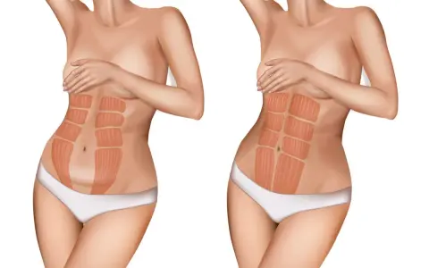 Vergleich zweier Bäuche: links ein Bauch nach Schwangerschaft mit deutlicher Trennung der Bauchmuskeln, rechts ein straffer Bauch mit sichtbaren Muskelpaketen.