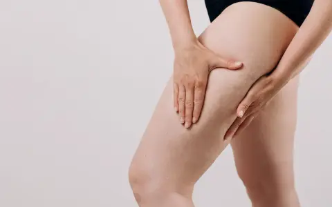 Une femme touche sa cuisse, montrant les capitons de la cellulite.