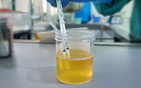 Testy paskowe zanurzone w próbce moczu, wskazujące na badanie pęcherza moczowego.