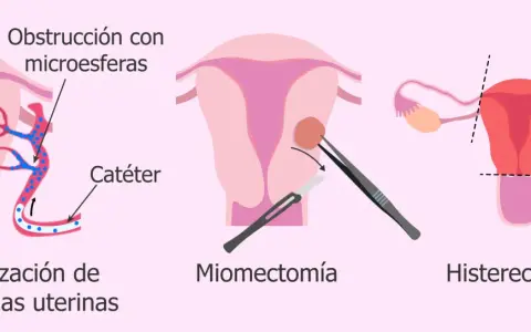 Ilustración de tratamientos para el mioma uterino: embolización, miomectomía y<bos> Histerectomía.
