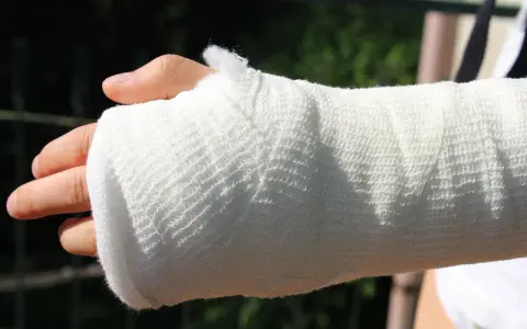 Ręka w gipsie po złamaniu kości księżycowatej.