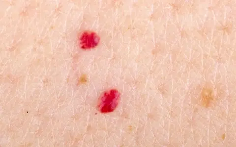 Zbliżenie na skórę z kilkoma intensywnie czerwone kropki na ciele, przypominające małe naczyniaki.