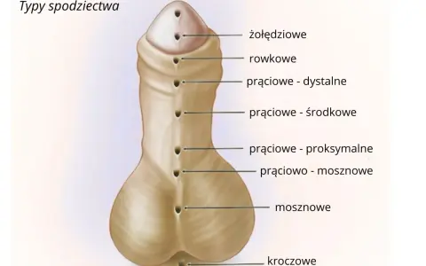 Ilustracja przedstawia typy spodziectwa, czyli wady rozwojowe cewki moczowej. Różne lokalizacje ujścia cewki mogą wpływać na obniżenie cewki moczowej objawy.