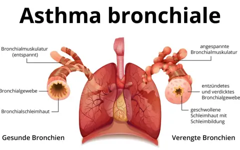 Vergleich gesunder und verengter Bronchien bei Asthma. Symptome wie angespannte Muskulatur und Schleimbildung führen zu Atemnot.