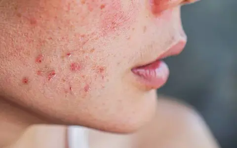 Ursachen für brennende Gesichtshaut: Symptome und wirksame Lösungen