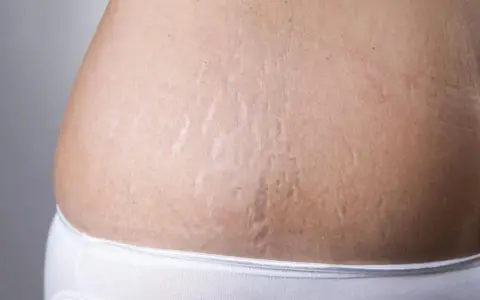 Widoczne rozstępy na brzuchu, które można zredukować zabiegiem dermapen.
