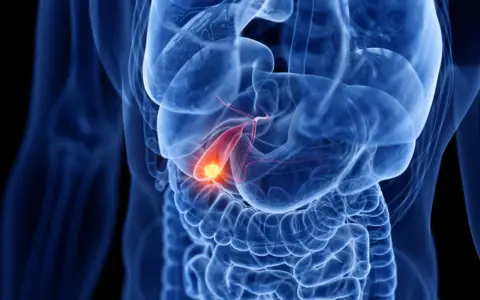 Anatomical rendering of a human torso showing the digestive system. A glowing yellow object, representing a gallstone, is visible within the **woreczek żółciowy**.