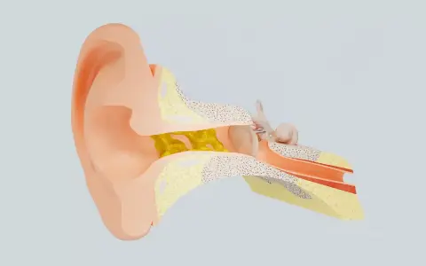 Sezione anatomica dell'orecchio con cerume giallo che blocca il condotto uditivo, impedendo all'acqua nelle orecchie di uscire.