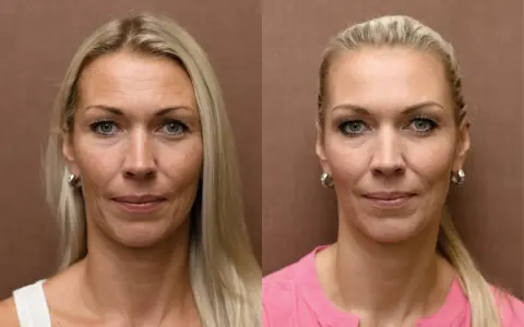 Przed i po zabiegu: widoczne wygładzenie zmarszczek i odmłodzenie skóry. Wampirzy lifting efekty zachwycają!