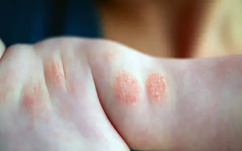 Plaques rouges et squameuses sur le bras d'un enfant, signe d'un petit bouton sur les bras allergie.