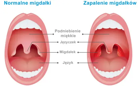 Porównanie budowy gardła: zdrowe migdałki po lewej, zapalone po prawej.