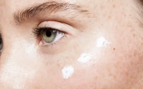 Nahaufnahme eines Auges mit Sommersprossen und drei Tupfern weißer Creme, die auf die Haut aufgetragen werden. Mögliche Ursachen für feuchte Haut.