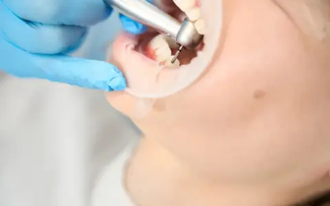 Co dentysta wkłada w zębodół po ekstrakcji? Wszystko, co musisz wiedzieć