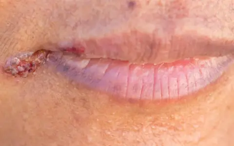 Czy z zajadami można iść do dentysty? Ważne informacje i porady