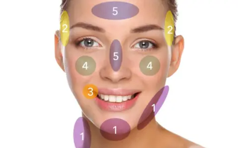 Gesichtszonen mit Nummern: 1 (Kinn/Hals), 2 (Schläfen), 3 (Mundwinkel), 4 (Wangen), 5 (Stirn/Nase). Hier könnten Pickel am Kinn auftreten.