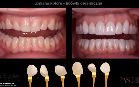 Przed i po metamorfozie zębów: od naturalnego koloru do olśniewającego, hollywoodzki uśmiech dzięki licówkom ceramicznym.