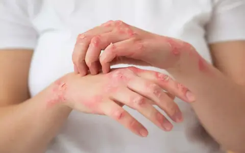 Mains atteintes de plaques rouges et squameuses, signe d'un psoriasis. La cause exacte reste complexe.