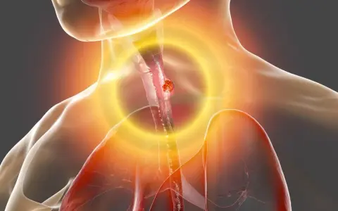 Cáncer de esófago: síntomas clave que no debes ignorar. ¿Los conoces?