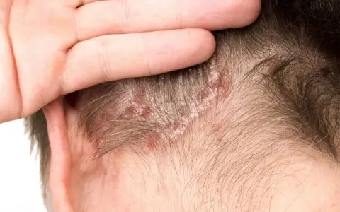 Main d'une personne touchant son cuir chevelu, révélant des plaques rouges et des squames cheveux.