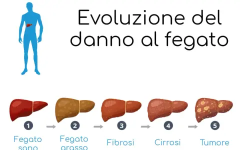 Illustrazione mostra l'evoluzione del danno al fegato: da sano a grasso, fibrosi, cirrosi e tumore.